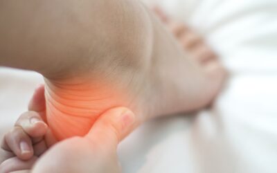 Plantarni fascitis – trn u peti